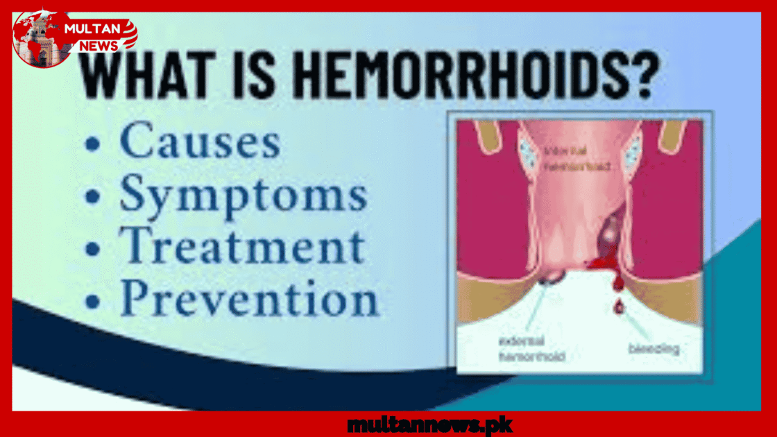HEMORRHOIDS